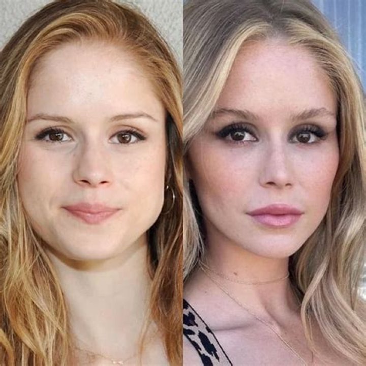 Erin Moriarty Plastic Surgery. The Boy's Annie January Starlight Buccal