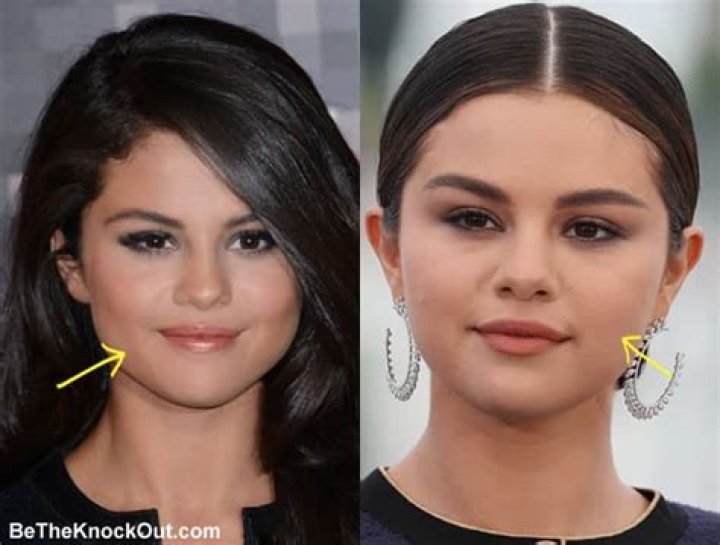 Every Plastic Surgery Selena Gomez Has Been Accused Of Having And